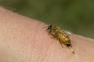 bee sting